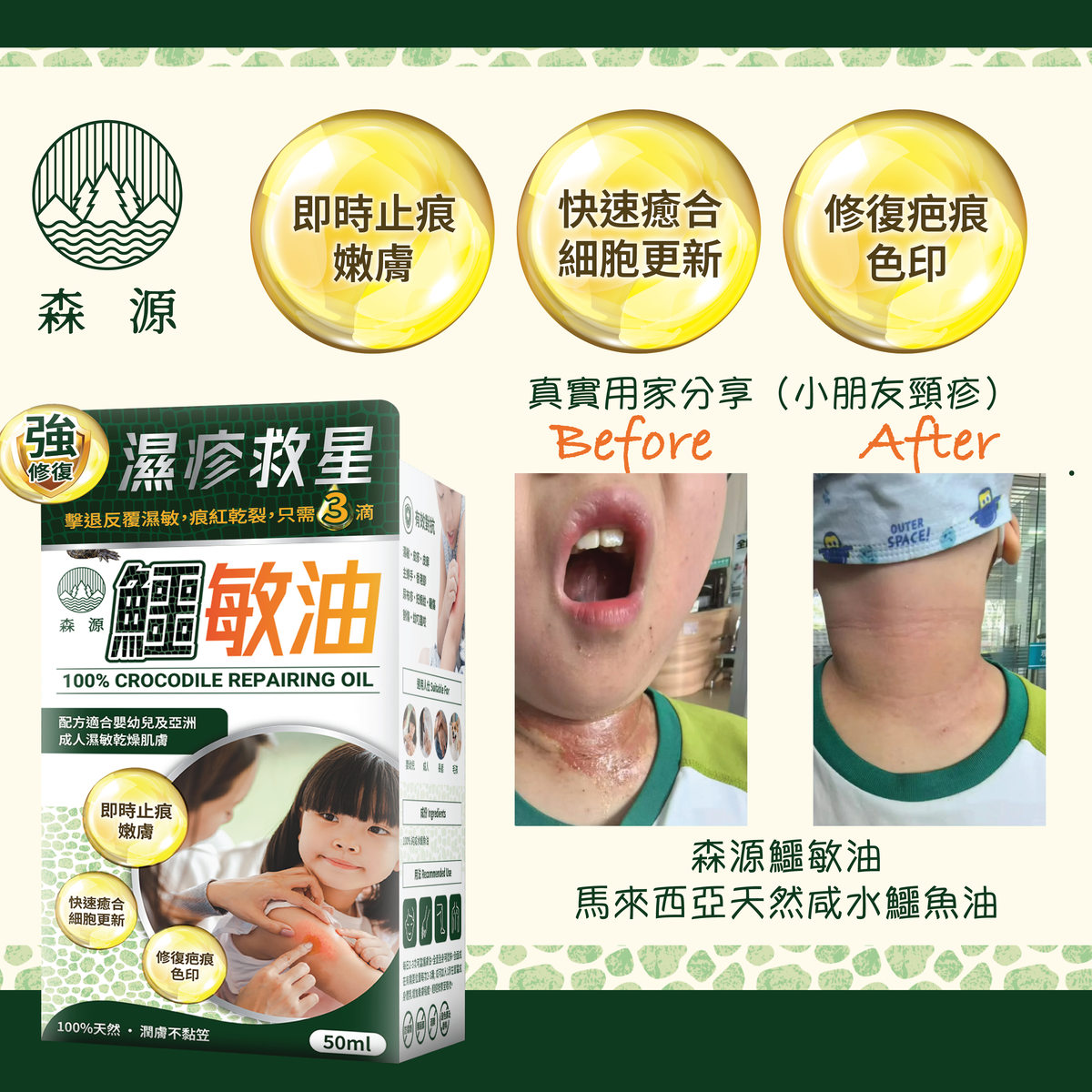 森源 鱷敏油+鱷敏膏 兩件套裝 香港製造